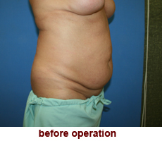 plastic-surgery-tummy-tuck